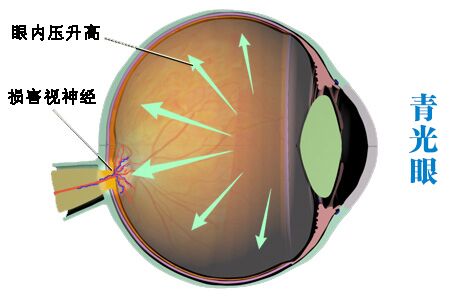 為什么眼壓升高可能會致盲?